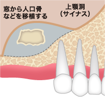 移植骨を移植