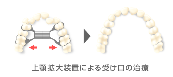受け口の治療