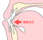 過剰舌圧