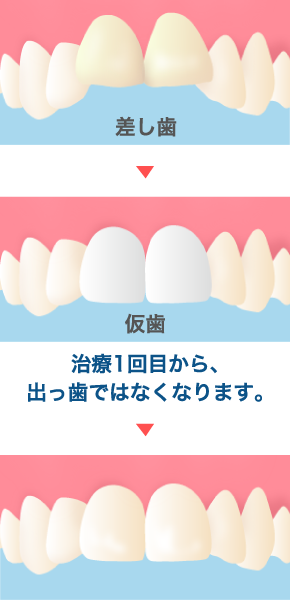 仮歯を装着