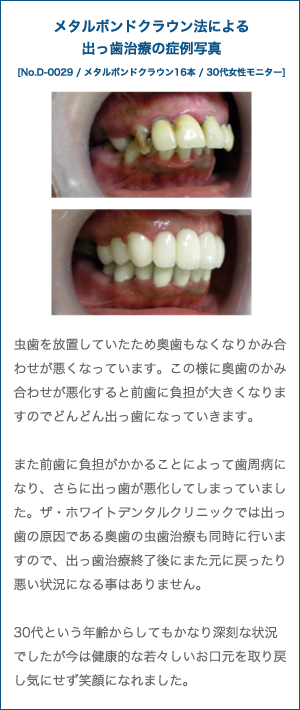 出っ歯治療の症例写真