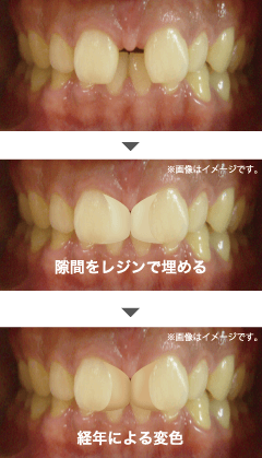 すきっ歯治療