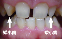 先天的に歯が小さい（矮小歯）