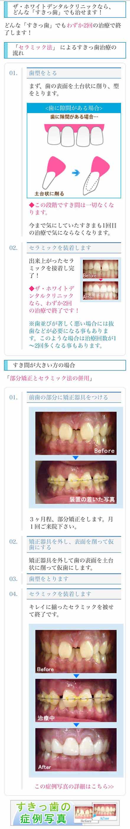 どんなすきっ歯でも治せます