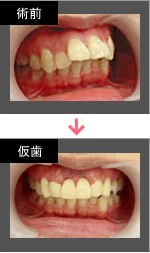 歯並びのお悩みでご来院した患者様の術前写真です